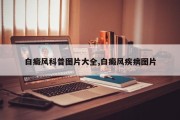 白癜风科普图片大全,白癜风疾病图片