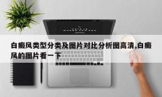 白癜风类型分类及图片对比分析图高清,白癜风的图片看一下