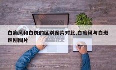 白癜风和白斑的区别图片对比,白癜风与白斑区别图片
