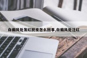 白癜风处发红脱皮怎么回事,白癜风处泛红