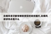 白癜风常识都有哪些类型的症状图片,白癜风症状特点是什么