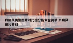 白癜风类型图片对比图分析大全简单,白癜风图片鉴别