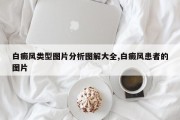 白癜风类型图片分析图解大全,白癜风患者的图片