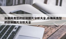 白癜风类型的区别图片分析大全,白癜风类型的区别图片分析大全