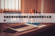 白癜风变好的症状图片,白癜风好转有什么变化
