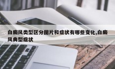 白癜风类型区分图片和症状有哪些变化,白癜风典型症状