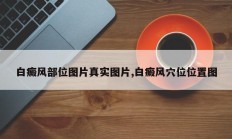 白癜风部位图片真实图片,白癜风穴位位置图