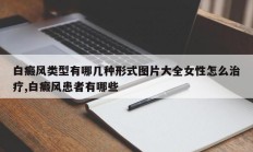 白癜风类型有哪几种形式图片大全女性怎么治疗,白癜风患者有哪些