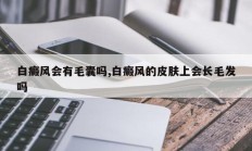 白癜风会有毛囊吗,白癜风的皮肤上会长毛发吗