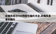 白癜风常识500例解析图片大全,白癜风患者的图片