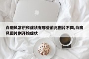白癜风常识和症状有哪些前兆图片不同,白癜风图片刚开始症状