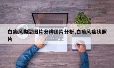 白癜风类型图片分辨图片分析,白癜风症状照片
