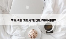 白癜风部位图片对比图,白癜风图样