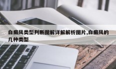 白癜风类型判断图解详解解析图片,白癜风的几种类型