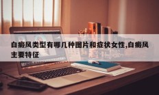 白癜风类型有哪几种图片和症状女性,白癜风主要特征