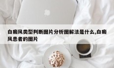 白癜风类型判断图片分析图解法是什么,白癜风患者的图片