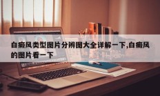白癜风类型图片分辨图大全详解一下,白癜风的图片看一下
