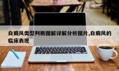 白癜风类型判断图解详解分析图片,白癜风的临床表现