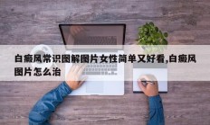 白癜风常识图解图片女性简单又好看,白癜风图片怎么治