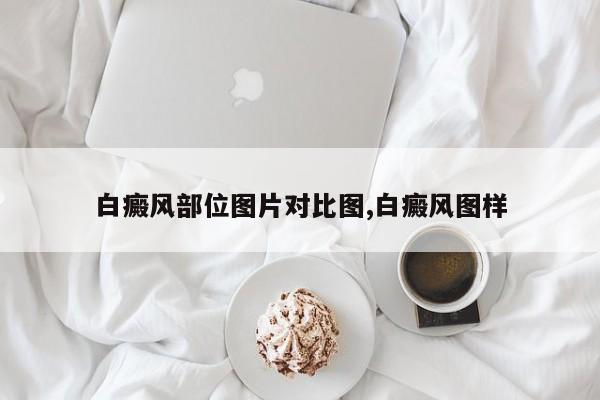 白癜风部位图片对比图,白癜风图样